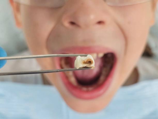 Best Emergency Dental Care for Sports Injuries in Milam, TX